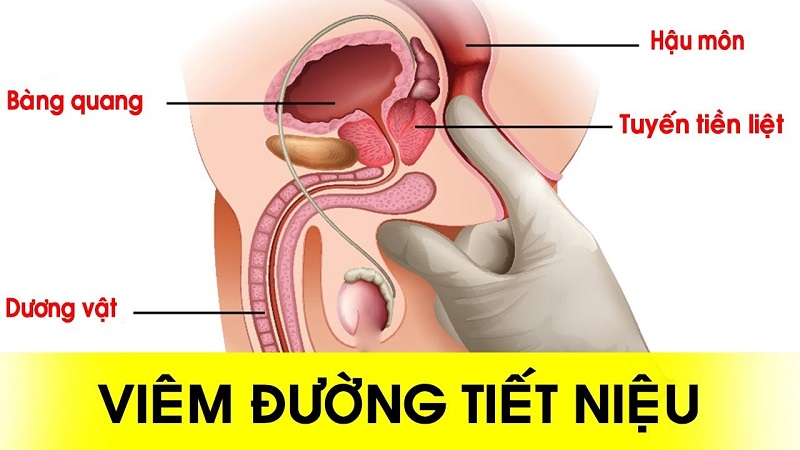 Viêm nhiễm đường tiết niệu gây phù nề tổ chức niêm mạc và có thể gây tắc nghẽn bí tiểu